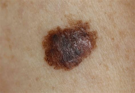 pictures of melanoma skin cancer on legs